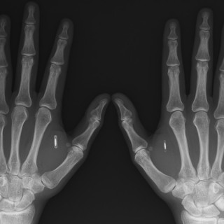 Εμφύτευση τσιπ NFC: H ώρα του Αντίχριστου έφτασε!