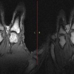 Πώς γίνεται οι αρθρώσεις μας να κάνουν θόρυβο;