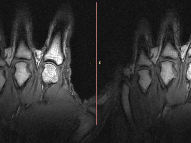Πώς γίνεται οι αρθρώσεις μας να κάνουν θόρυβο;