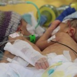 Ελβετία: Σιαμαία διαχωρίστηκαν οκτώ ημέρες μετά τη γέννησή τους