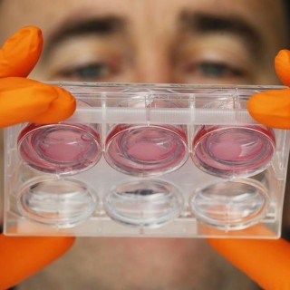 Αιματολογικό τεστ για την πρόωρη οστεοαρθρίτιδα