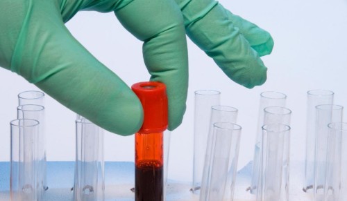 Νέο τεστ αίματος κάνει πιο γρήγορη διάγνωση του εμφράγματος