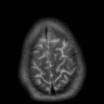 Το χαμηλό εισόδημα επηρεάζει αρνητικά τον εγκέφαλο ακόμη και στη μέση ηλικία, σύμφωνα με νέα έρευνα