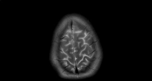 Κάθε 3 δευτερόλεπτα κάποιος στον κόσμο εμφανίζει άνοια