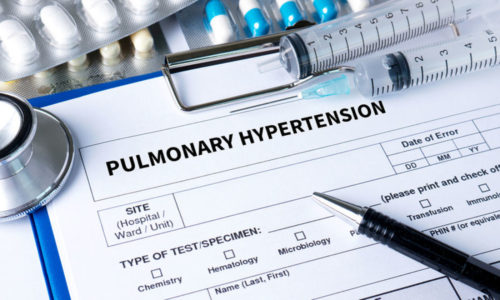 Φως στο γενετικό υπόβαθρο της πνευμονικής αρτηριακής υπέρτασης