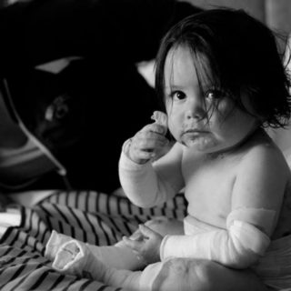 Τα παιδιά-πεταλούδες υποφέρουν από τη χειρότερη ασθένεια που ίσως να μην έχετε ακούσει ποτέ