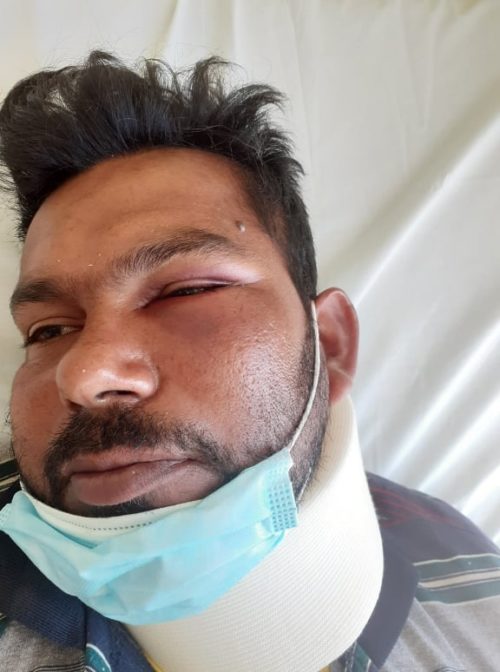 Ηλεία: Ξυλοδαρμός μετανάστη-εργάτη. Καταγγελίες για «πρακτικές Μανωλάδας»