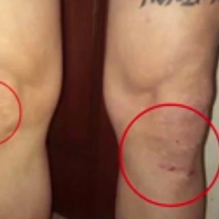 Κατερίνη: Ο πατέρας που ξυλοκόπησαν βάναυσα οι αστυνομικοί έχει αναπηρία 80%