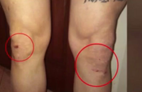 Κατερίνη: Ο πατέρας που ξυλοκόπησαν βάναυσα οι αστυνομικοί έχει αναπηρία 80%