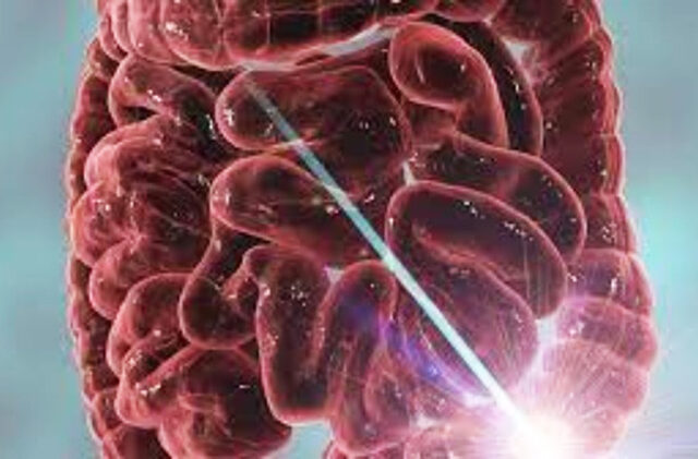 Οι παρεμβάσεις στη διάθεση μπορούν να μειώσουν τη φλεγμονή στη νόσο του Crohn και την ελκώδη κολίτιδα