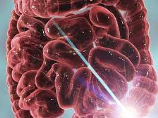 Οι παρεμβάσεις στη διάθεση μπορούν να μειώσουν τη φλεγμονή στη νόσο του Crohn και την ελκώδη κολίτιδα