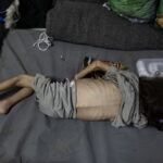 Πόλεμος στη Γάζα: Ακόμη ένα παιδί πέθανε από υποσιτισμό