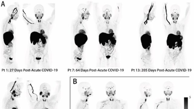Οι ασθενείς με Long Covid μπορεί να εμφανίζουν σημάδια μη φυσιολογικής ενεργοποίησης των ανοσοποιητικών κυττάρων για χρόνια